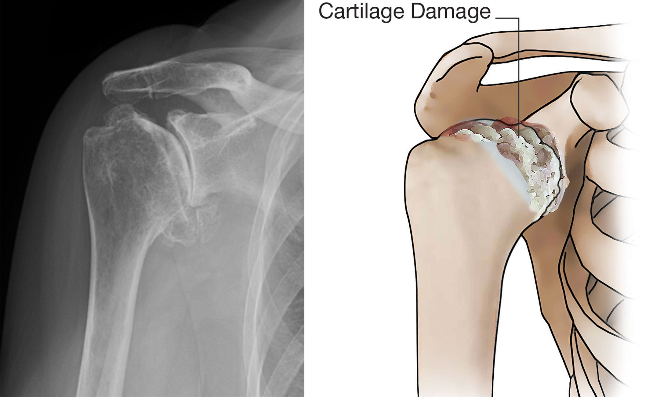 Shoulder arthritis evaluation at ReVive Orthopedics