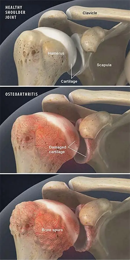Illustration of arthritis in the shoulder joint