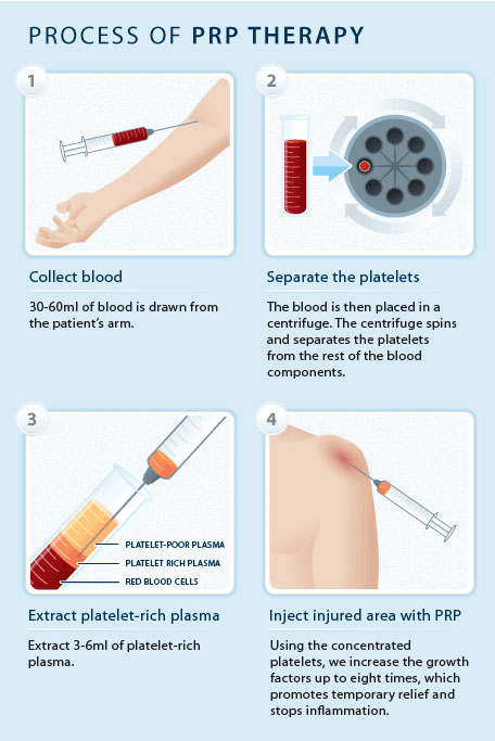 PRP Process